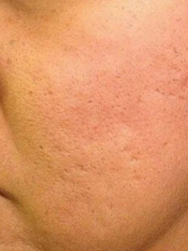 After - Day 45