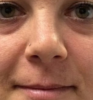 Before - Day 1
