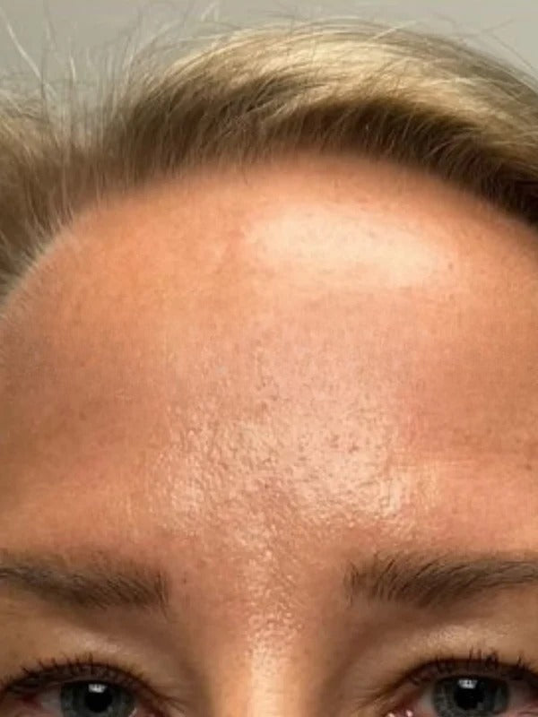 After - Day 45