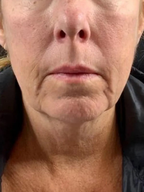 Before - Day 1