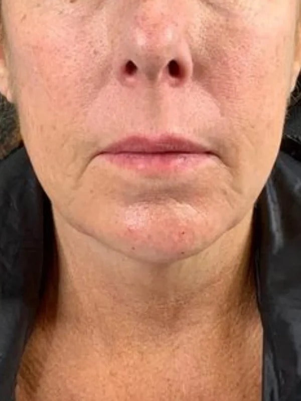 After - Day 30