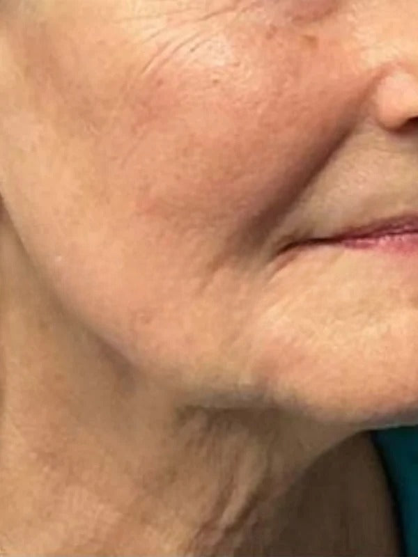 After - Day 45