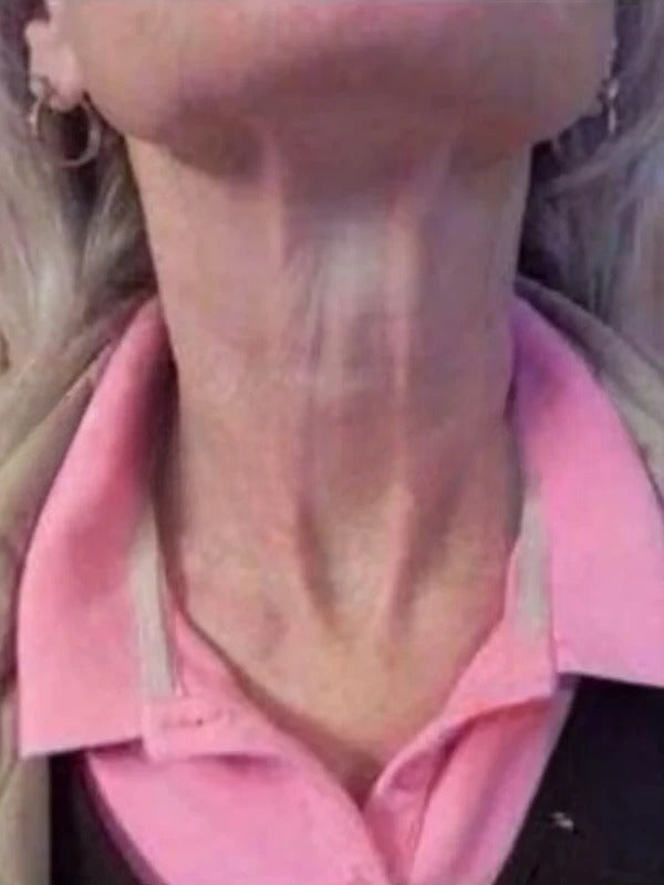 After - Day 45
