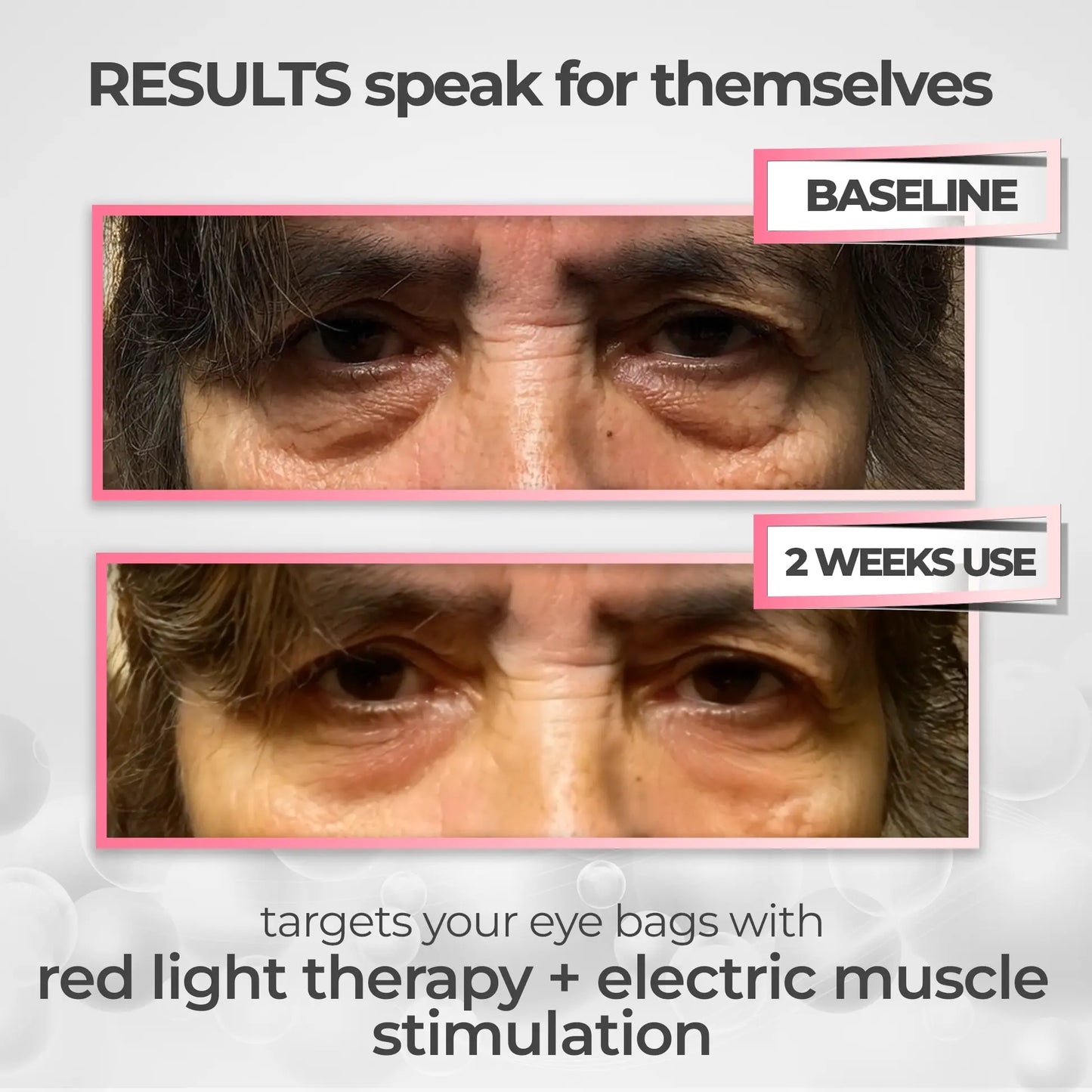 VAURA® 2-in-1 Red Light Therapy + EMS To Erase Eye Bags