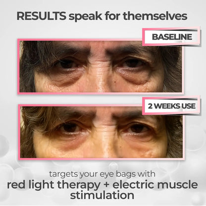 VAURA® 2-in-1 Red Light Therapy + EMS To Erase Eye Bags