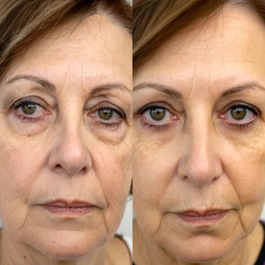 VAURA® 2-in-1 Red Light Therapy + EMS To Erase Eye Bags