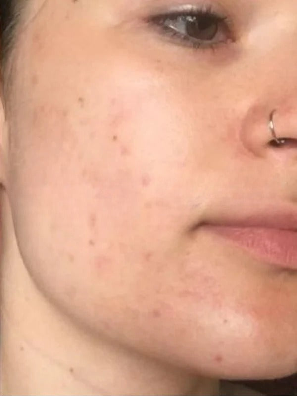 After - Day 45