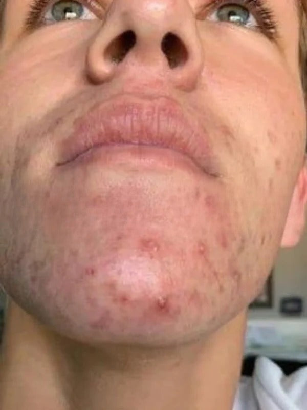 Before - Day 1