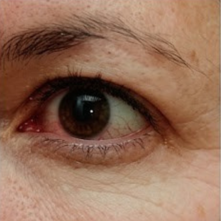 Before - Day 1