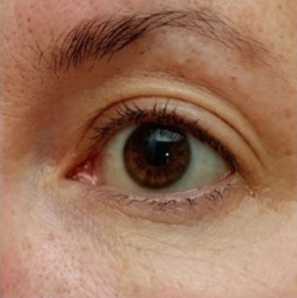 After - Day 45