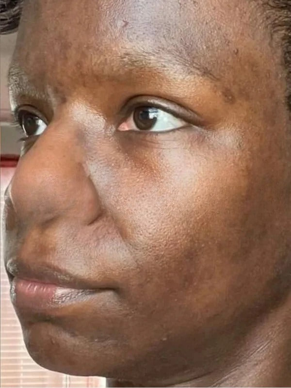After - Day 45