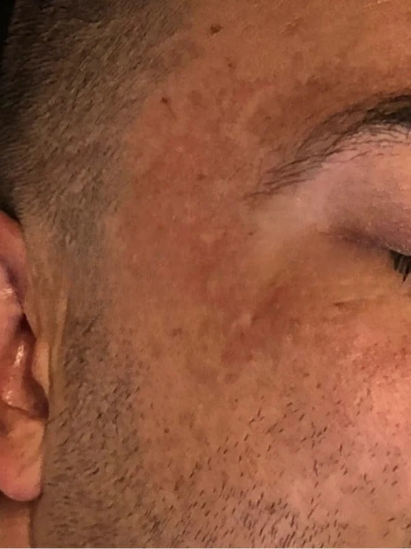 Before - Day 1