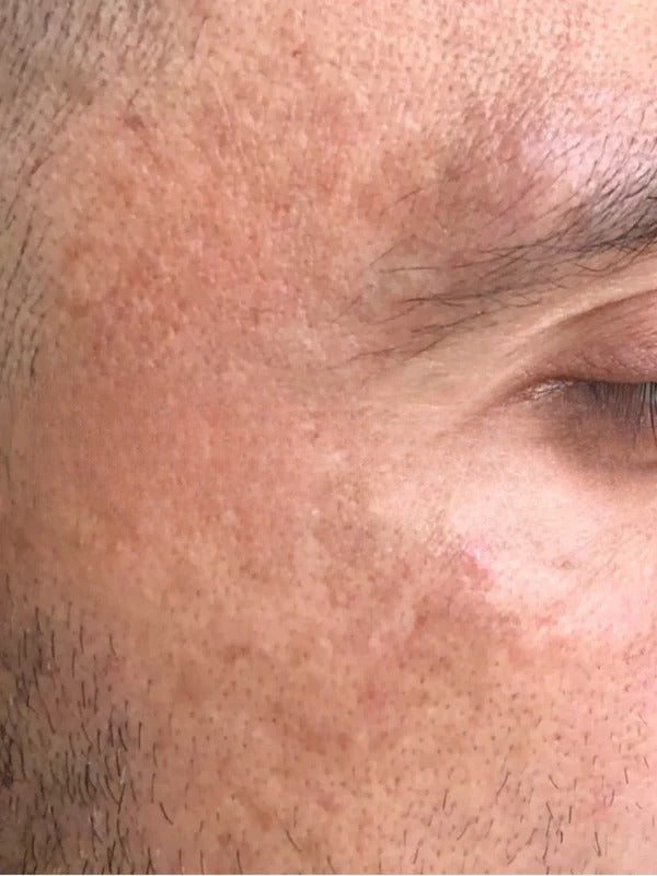 After - Day 60
